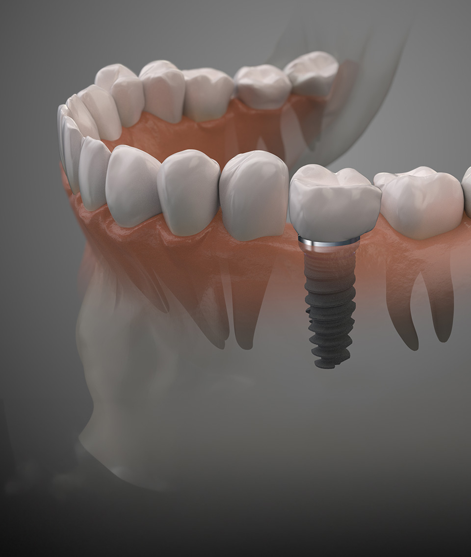 Išskirtiniai dantų </br>implantacijos pasiūlymai